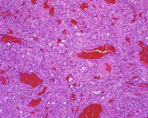 Figure 19 from Histopathology of Spindle Cell Vascular Tumors. | Semantic Scholar