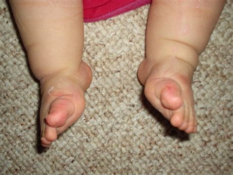 Newborn Baby Foot Problems and Deformities