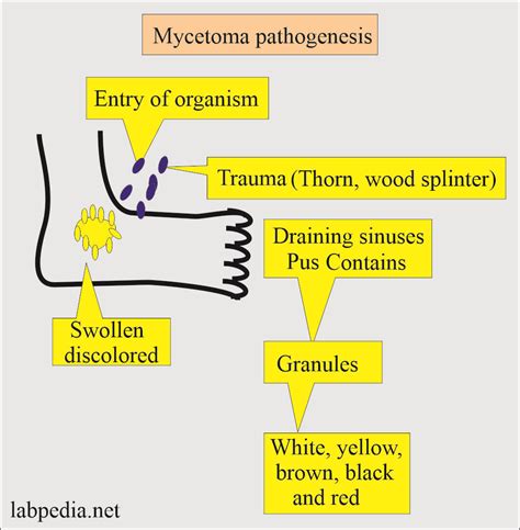 Mycetoma