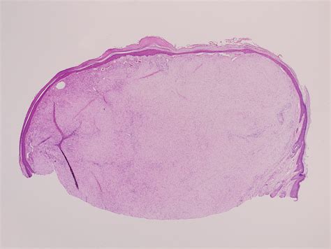 Fibrous Papule Histology