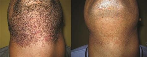 Beard Ingrown Hair Removal - Pin on Beard Care - hanyatakankembali