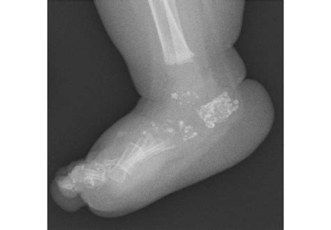 An infant with chondrodysplasia punctata. Multiple puncta are seen in... | Download Scientific ...