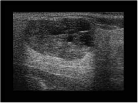 Head and Neck | 4.3 Salivary glands : Case 4.3.4 Warthin's tumors ...