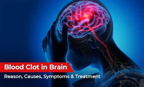 Blood Clot in Brain: Causes, Symptoms & Treatment - PSRI Hospital