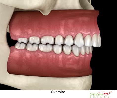 Overbite Teeth: What is an overbite or Buck Teeth?, Treatment, Causes ...