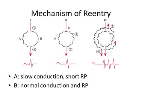 Short Approach to SVT and AVNRT management | Epomedicine