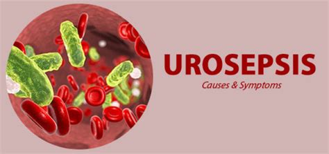 A Brief Insight into Urosepsis, Its Causes, And Symptoms – HealthInfoNetwork