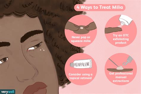 Milia Removal: Safe Ways to Get Rid of White Face Bumps