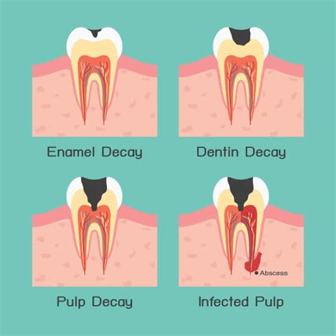 Tooth Pain: Reasons Your Tooth is Paining! - sicknessnhealth.com