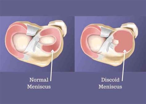 Discoid Meniscus Surgery | Complex Knee Surgeon | Minnesota