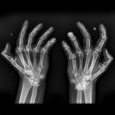 Rheumatoid arthritis x ray - wikidoc