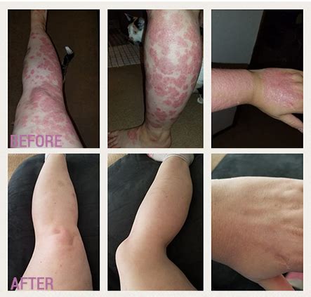 Results – Comizla Psoriasis Cream