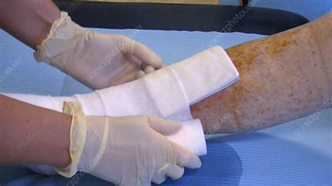 Leg ulcer dressing - Stock Video Clip - K003/3864 - Science Photo Library