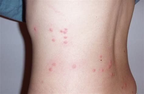 Flea Bites Vs. Bed Bug Bites : Symptoms, Treatment, Pictures, Home Remedies
