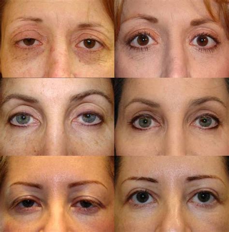 Ptosis Surgery or Blepharoplasty Surgery - Cosmetic Eyelid Surgery in ...