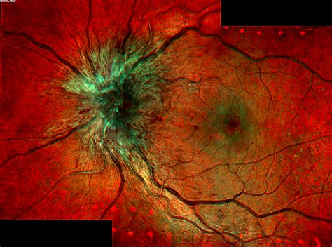 Vein Occlusion (Eye Stroke) - Edgbaston Eye Clinic