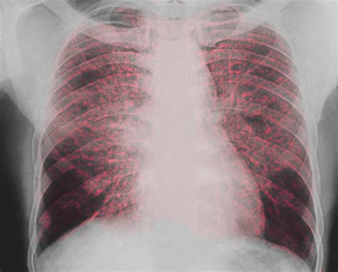 Pulmonary Sarcoidosis: Independent Predictors of Mortality - Pulmonology Advisor