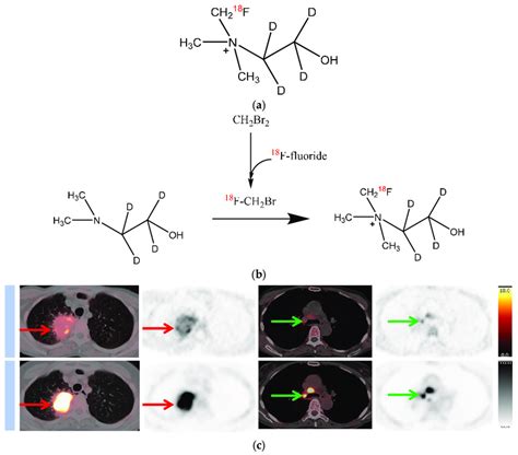 Chemical structure and synthesis of [ 18 F]D4-FCH, and images of [ 18... | Download Scientific ...