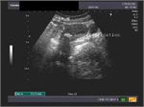 A Gallery of High-Resolution, Ultrasound, Color Doppler & 3D Images - Uterus