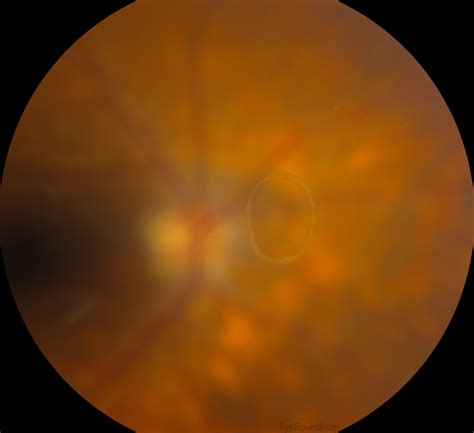 Vitreous Syneresis: An Impending Posterior Vitreous Detachment (PVD)