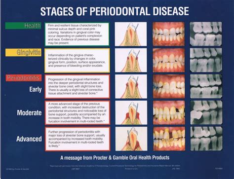 Stages of periodontal disease. #dentistry | Dental hygiene school, Dental hygiene student ...
