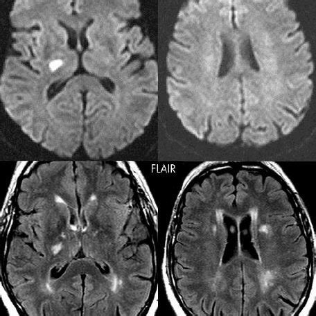 MRI imaging pattern not suggestive of microangiopathy (two DWI lesions ...