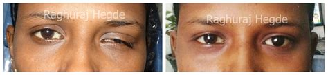 Customized Eye Prosthesis Surgery – DR. RAGHURAJ HEGDE