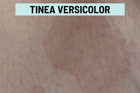 Tinea Versicolor: Healing Stages, Pictures, and Treatment