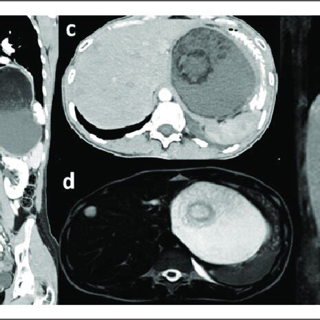 Surgical specimen. Dermoid cyst (ruptured) along with spleen and ...