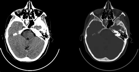 Sphenoid Sinus CT Scan