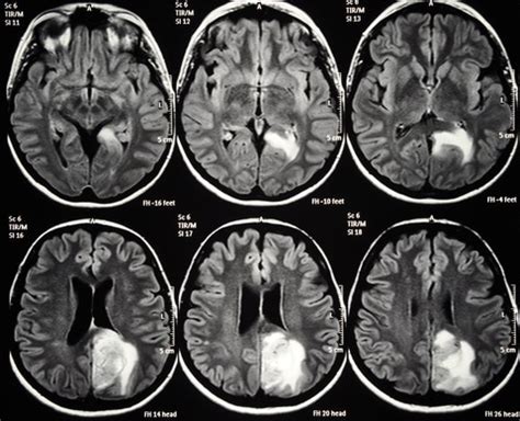 Brain Lesion Detection in MRI Images with Graph-cut Algorithms