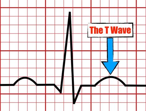 The T Wave — The PR Segment.com