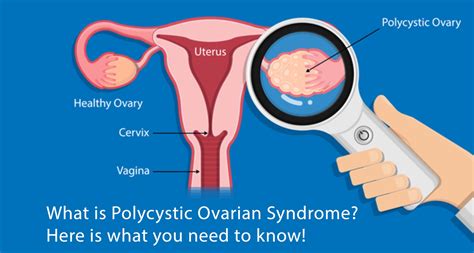 Best Polycystic Ovary Syndrome (PCOS) Doctors In Jalandhar | Chawla Nursing Home & Maternity ...