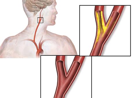 Carotid Artery Stenosis Ultrasound Diagnosis | SIFSOF