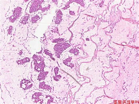 mucinous carcinoma breast histology