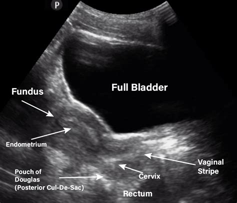 Gynecology/Pelvic Ultrasound Made Easy: Step-By-Step Guide | Ultrasound, Medical ultrasound ...