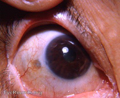 Nodular scleritis: residual scleral thinning. EyeRounds.org: Online ...