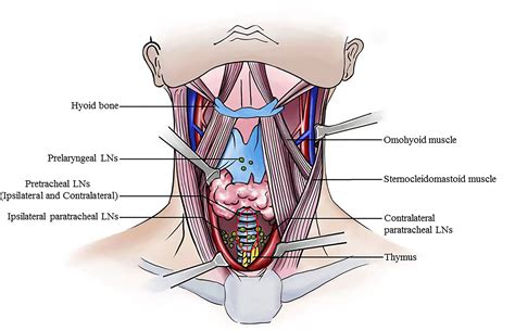 Frontiers | Pretracheal Lymph Node Subdivision in Predicting ...