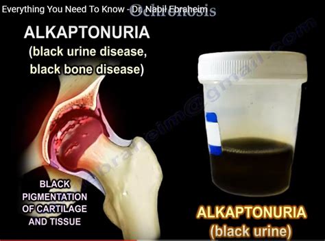 Ochronosis — OrthopaedicPrinciples.com