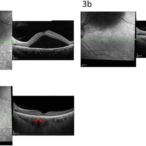 Baseline brain MRI T2 showed focal thickening with enhancement at the... | Download Scientific ...