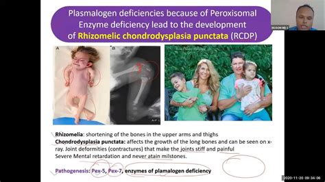 lipid 6.9: Rhizomelic Chondrodysplasia Punctata (RCDP) - YouTube