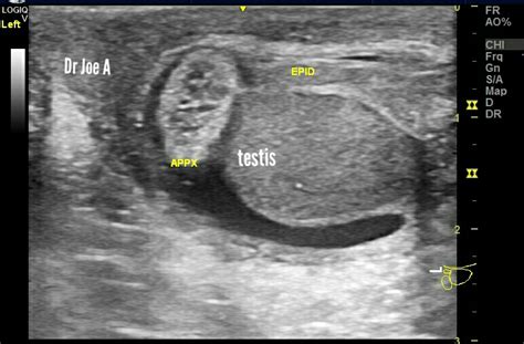 Ultrasound imaging