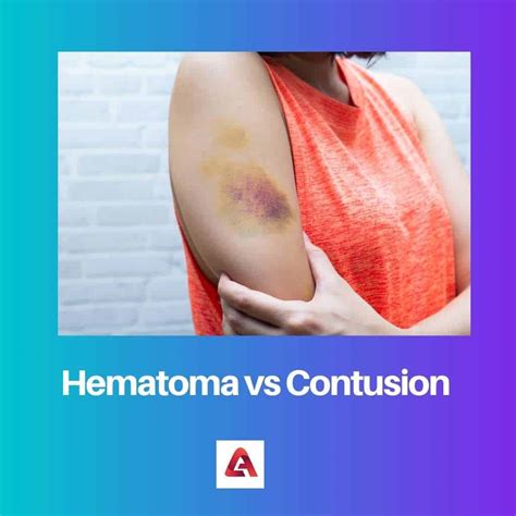 Hematoma vs Contusion: Difference and Comparison