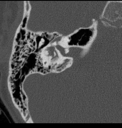 Inner ear malformations (classification) | Radiology Reference Article | Radiopaedia.org