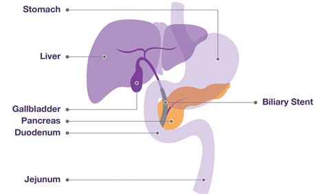 Duodenal stent | Pancreatic Cancer Action | Pancreatic Cancer