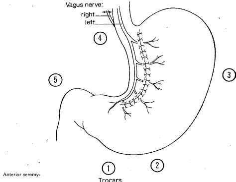 Figure 1 from Laparoscopic Po sterior Truncal Vagotomy and Anterior Seromyotomy | Semantic Scholar