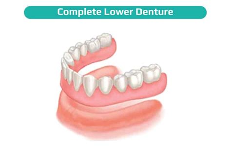 Best Wisdom Tooth Removal Treatment in Mumbai- ToothFix