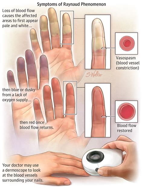 Raynaud Phenomenon | Cardiology | JAMA Dermatology | JAMA Network