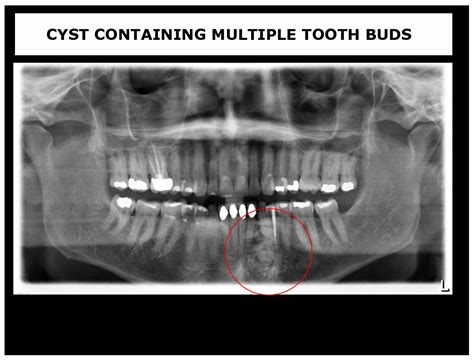 X-Ray Pathology | My Family Dentist