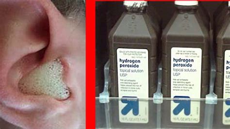 hydrogen peroxide in ear - hydrogen peroxide in ear